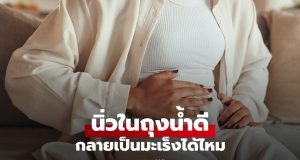 นิ่วในถุงน้ำดี กลายเป็นมะเร็งได้ไหม? สังเกต 4 สัญญาณเตือนที่ไม่ควรมองข้าม